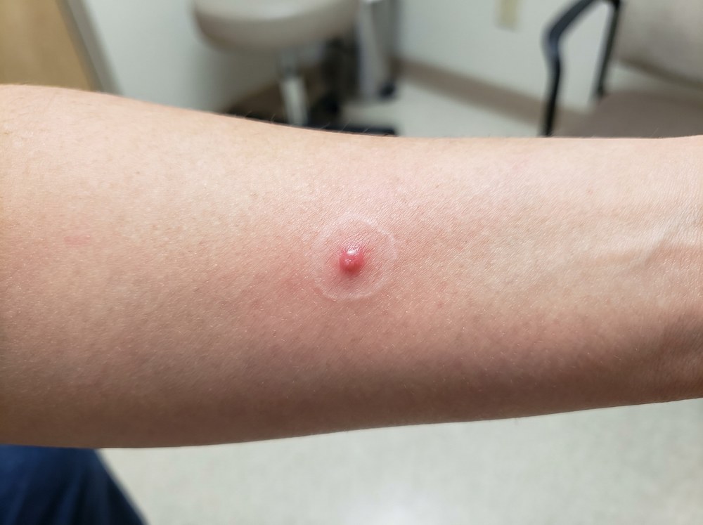 Close-up photo of a black widow spider bite mark on skin showing a small pale halo surrounded by a faint ring of redness